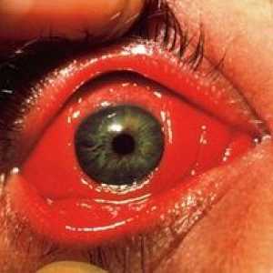 Očná masť z konjunktivitídy u dieťaťa a dospelých