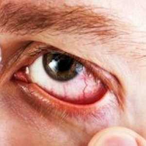 Diklofenac očné kvapky: návod na použitie, cena