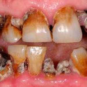 Zhnité zuby u dieťaťa a dospelého: prečo zuby začnú hniť