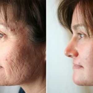 Chemický tvárný peeling: výhody a nevýhody postupu