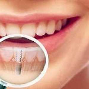Implantácia zubov: podstatou postupu pre vytvorenie zubného implantátu