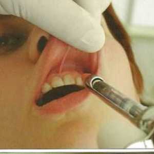 Infiltračná anestézia v stomatológii: vlastnosti
