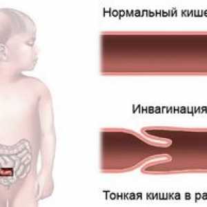 Invázia čreva u dieťaťa - čo to je?