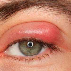 Jačmeň na oku: čo robiť a ako sa má liečiť