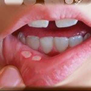 Nákaza v ústach a príčiny liečby