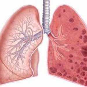 Emfyzém pľúc - čo je to a prognóza života