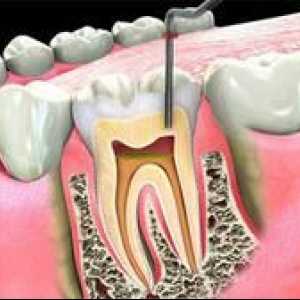 Endodontická stomatológia v zubnom lekárstve: čo to je?