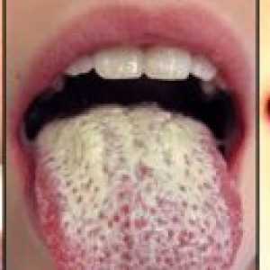 Ako sa zbaviť bieleho plaku v jazyku
