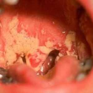 Ako sa zbaviť drozdov v ústach dospelého?