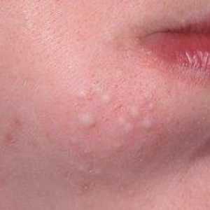 Ako sa zbaviť vnútorného akné na tvári?