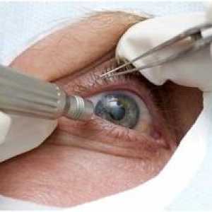 Ako liečiť artefaktívne oči a čo to je