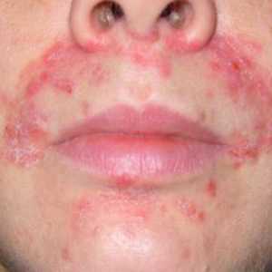 Ako liečiť dermatitídu na tvári: spôsoby, fotky choroby