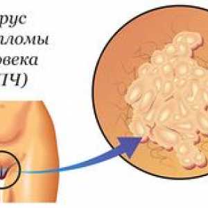 Ako liečiť ženy s HPV typu 16