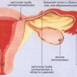 Ako identifikovať príznaky mimomaternicového tehotenstva v ranom veku