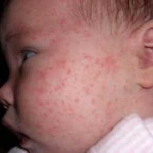 Ako sa prejavuje alergia na potravu u dieťaťa, ako na liečbu vyrážky na tvári