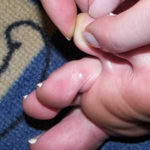 Ako odstrániť mozoly z prstov
