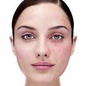 Ako odstrániť stopy akné na tvári doma?