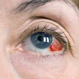 Jodid draselný: pokyny na používanie jódových očných kvapiek