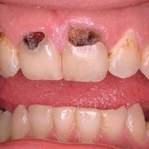 Zubné kazy predných zubov: príčiny a liečba ochorenia