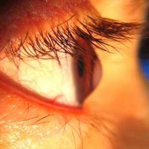 Keratokonus oka: konzervatívna a chirurgická liečba
