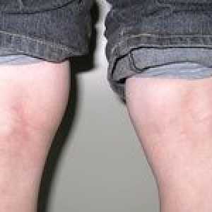 Beckerova cysta pod kolenom - ako nebezpečné a ako sa liečiť?