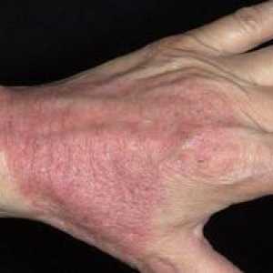 Kontaktná dermatitída: fotografie, príznaky a liečba