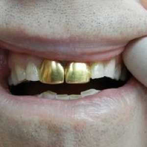Korunky na zuboch: hlavné typy a ich charakteristiky