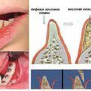 Kostná plasticita pre implantáciu zubov: popis a cena