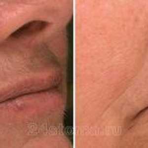Laserové odstránenie chĺpkov na tvári u žien