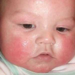 Liečba atopickej dermatitídy u detí lekármi proti komárom