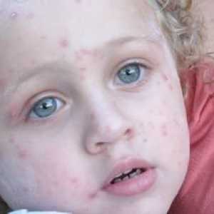 Liečba herpesu u detí, foto vonkajších prejavov patológie