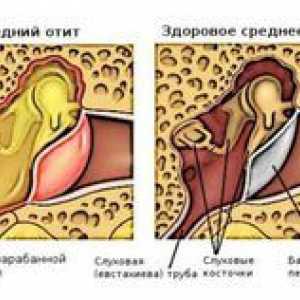 Liečba hnisavého zápalu stredného ucha u detí