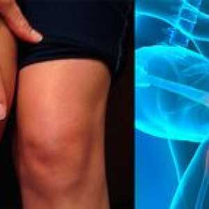 Liečba gonartrózy kolenného kĺbu 2. stupňa: príznaky ochorenia