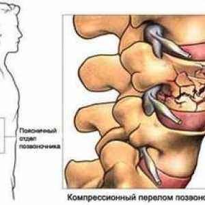Liečba kompresnej zlomeniny bedrovej chrbtice