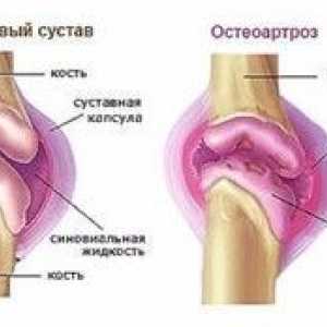 Liečba osteoartrózy kolena 2. stupňa