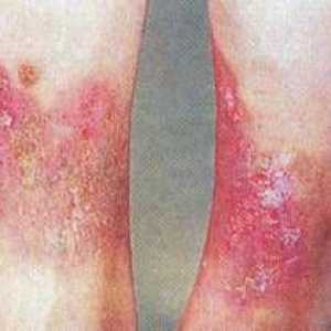 Lipodermatoskleróza alebo varikózna dermatitída: príznaky