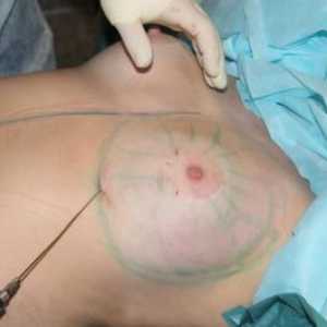 Lipofilling prsných žliaz: črty operácie
