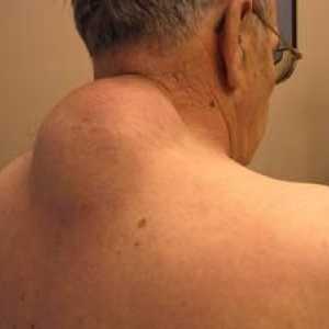 Spôsoby liečenia wenu na chrbte a fotografie lipómu