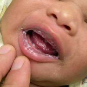 Draslík v ústach v liečbe dieťaťa