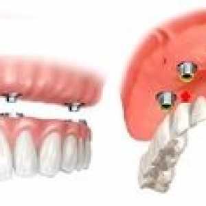 Fixované zubné protézy: typy, cena