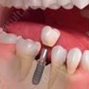 Okamžitá implantácia zubov: ceny a opis metódy