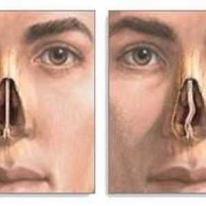 Operácia na zakrivenie nosnej septa a diagnostika odchýlky