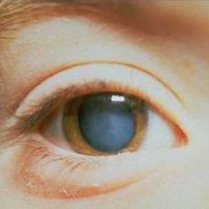 Komplikovaná katarakta oboch očí: čo je táto patológia?