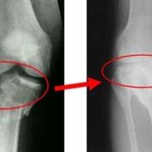 Hlavné metódy liečby gonartrózy kolenného kĺbu tretieho stupňa