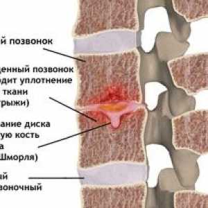 Vlastnosti hernie shmorlya a princípy liečby chrbtice