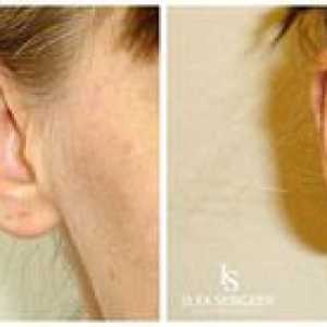 Vlastnosti plastického chirurgického zákroku na korekciu ušných pier