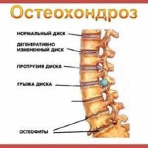 Osteochondróza krčnej chrbtice, príznaky a liečba