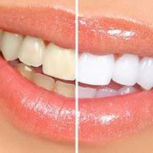 Bielenie zubov úžasné biele: vlastnosti postupu