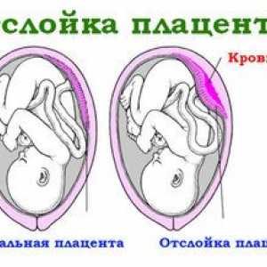 Placentálna abrupcia v začiatku tehotenstva