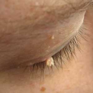 Papilómy na tvári: funkcie liečby a fotografie